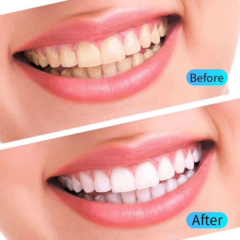 Teeth Whitening Gel Kit